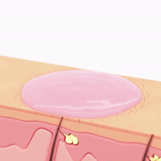 Skin Rippling Gif Dreamiskin